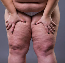 Carregar imagem no visualizador da galeria, Formação Lipedema na area da Estética dias 5 e 6 Outubro 2026