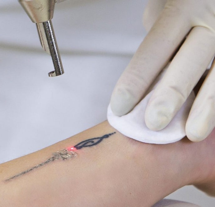 Formação Laser ND-YAG. Remoção Tatuagem, Micropigmentação e Carbon Peel (Hollywood Peel). Dia 7 Fevereiro 2024 LEIRIA